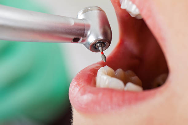 Best Emergency Root Canal Treatment in Galveston, IN